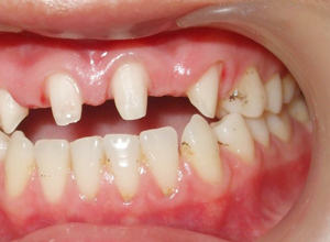 牙缝大也是牙病信号